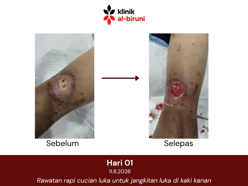 Wound dressing