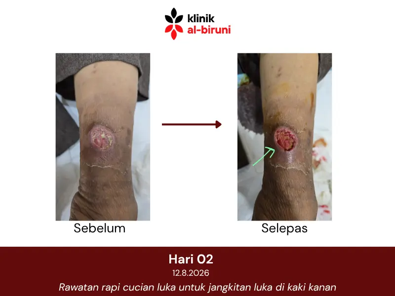 Wound dressing