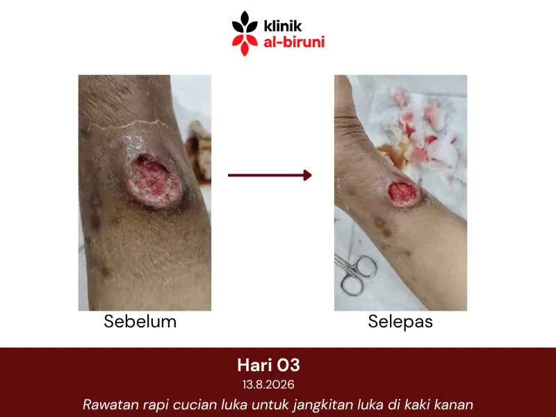 Wound dressing
