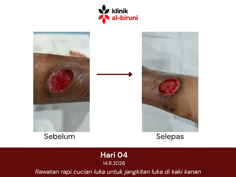 Wound dressing