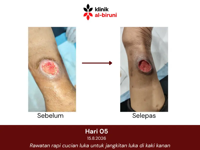 Wound dressing