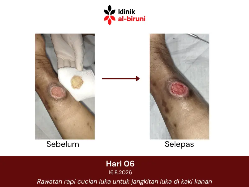 Wound dressing