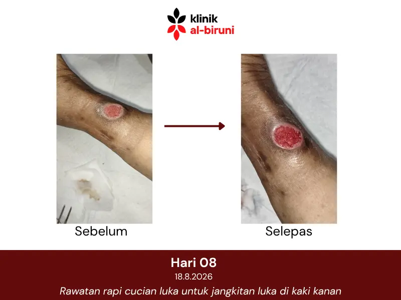 Wound dressing