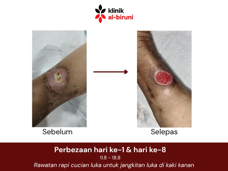 Wound dressing