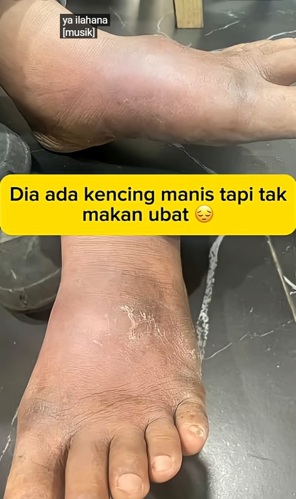 Wound treatment video