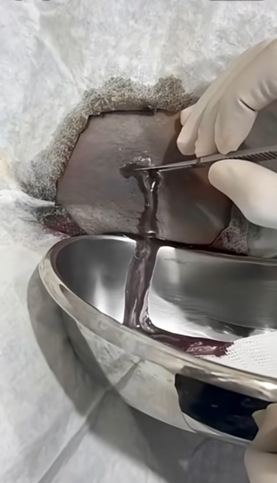 Wound treatment video