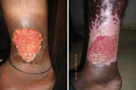 Wound dressing